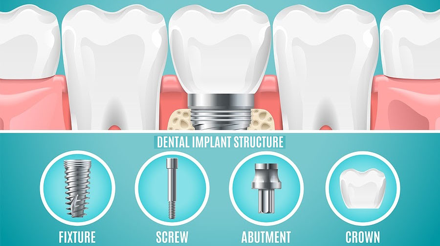 Dental Implant